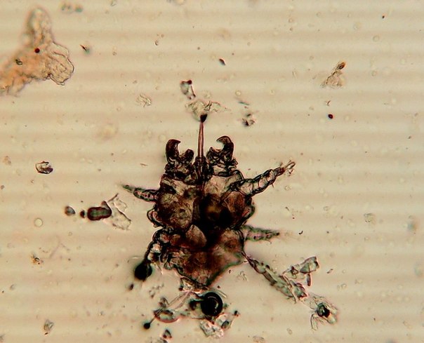 Микроскопическое исследование соскоба с кожи на грибы (дрожжевые, плесневые, дерматомицеты)